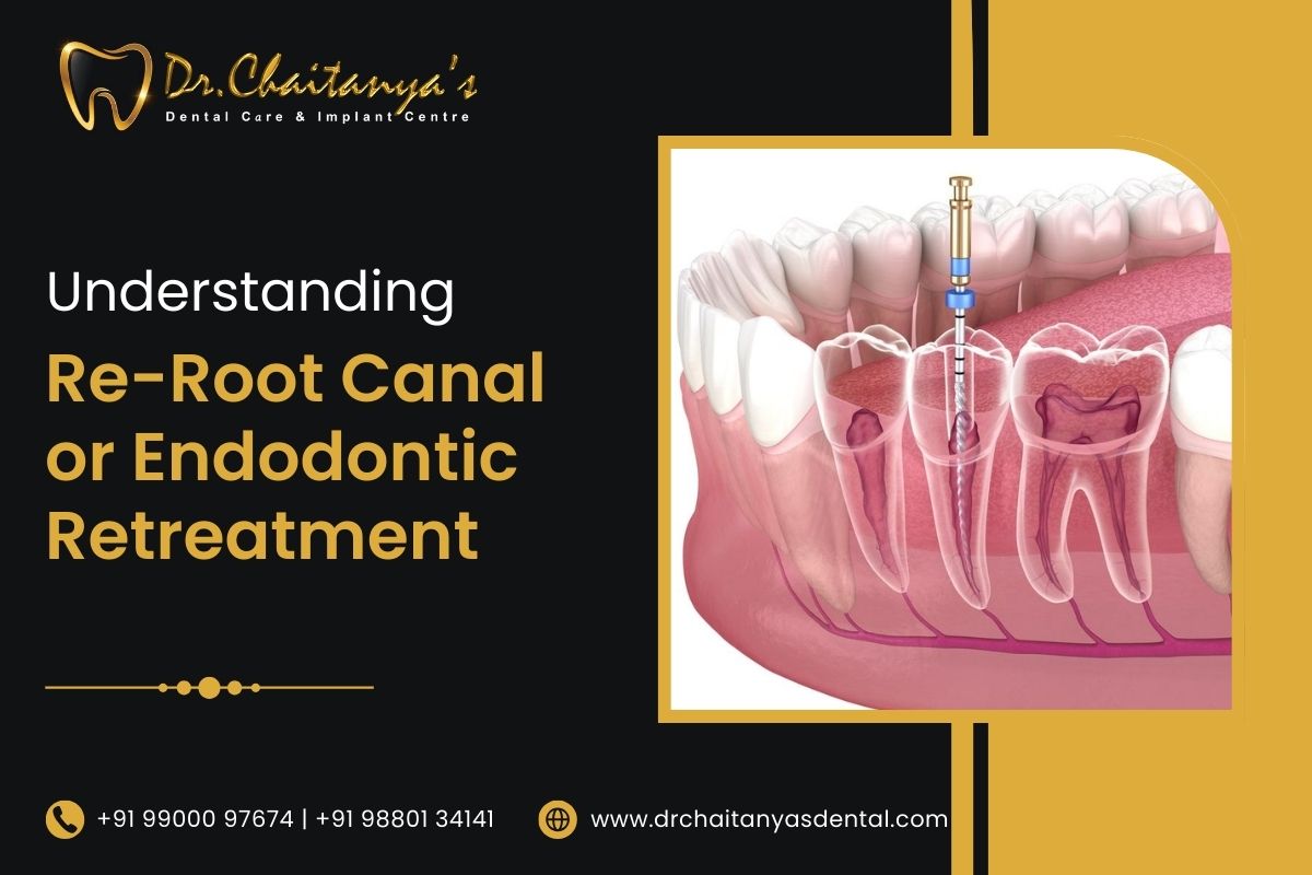 Re-Root Canal